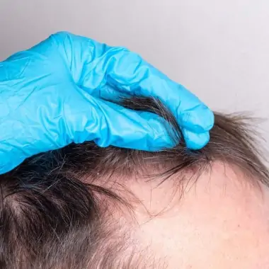 Afinal, transplante capilar sem raspar o cabelo é possível? Confira!